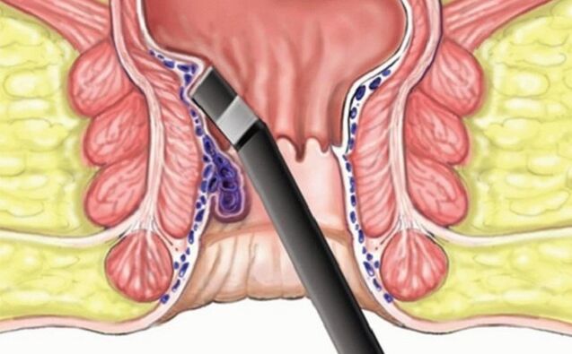 Clotting of hemorrhoids into hemorrhoids